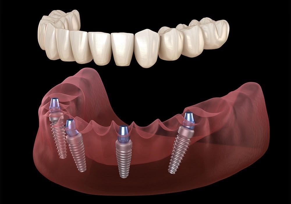 Prothèse complète All-on-4 sur quatre implants