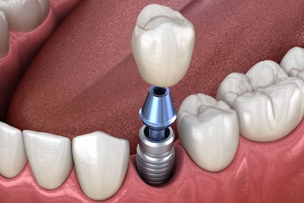 Implant unitaire avec pilier et couronne