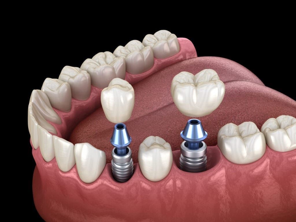 Deux implants dentaires avec couronnes